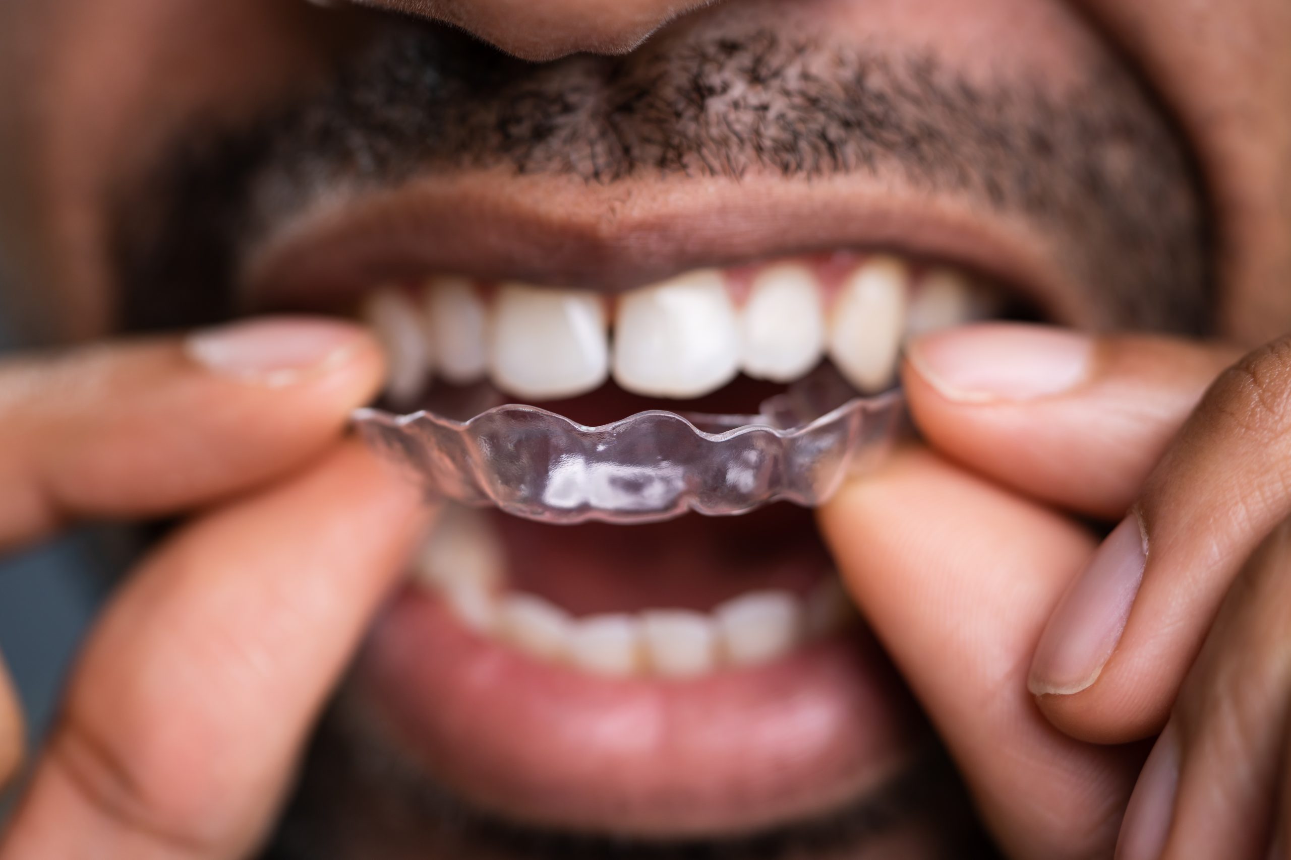 clear aligners