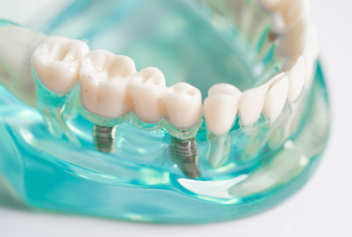 How Modern Dental Implants Have Changed in 20 Years (and What That Means for You)
