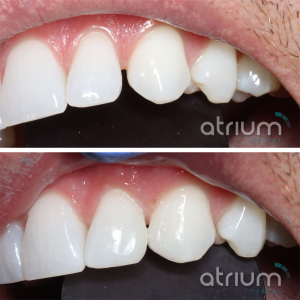 before and after of composite bonding, closing a gap