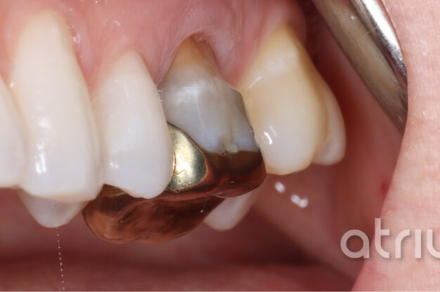 CEREC (Crowns)-Before Img