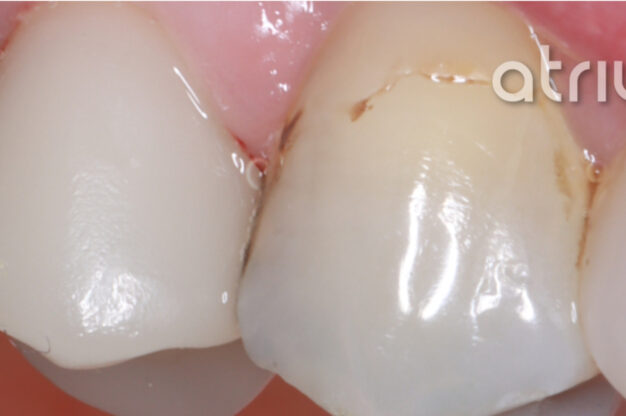 CEREC (Crowns)-After Img