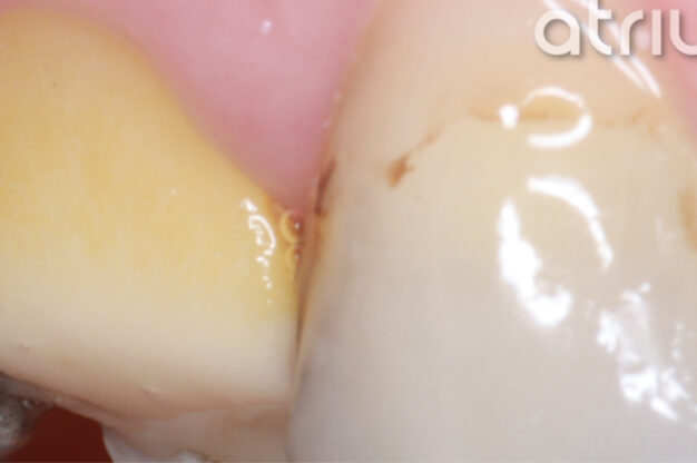CEREC (Crowns)-Before Img