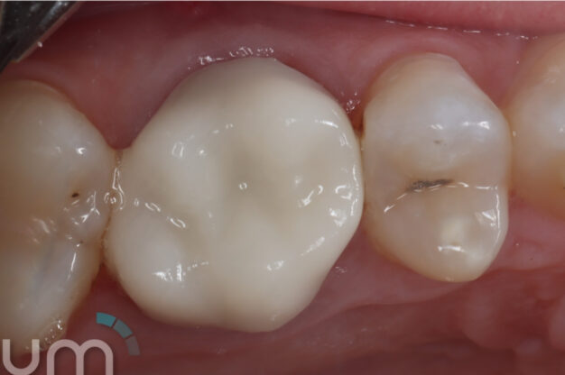 CEREC (Crowns)-After Img