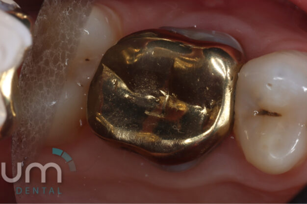 CEREC (Crowns)-Before Img
