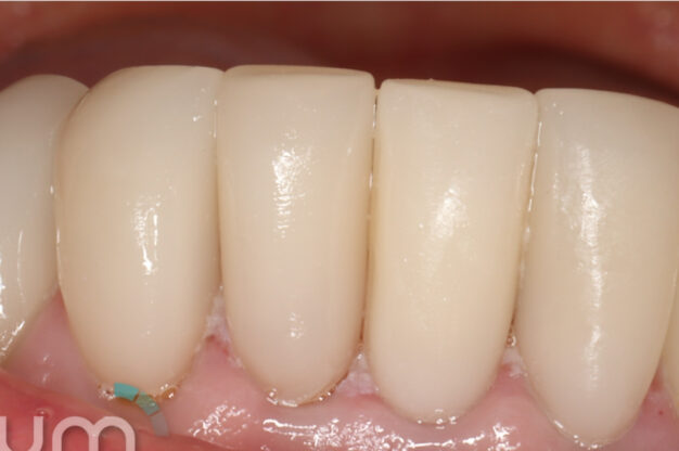 CEREC (Crowns)-After Img