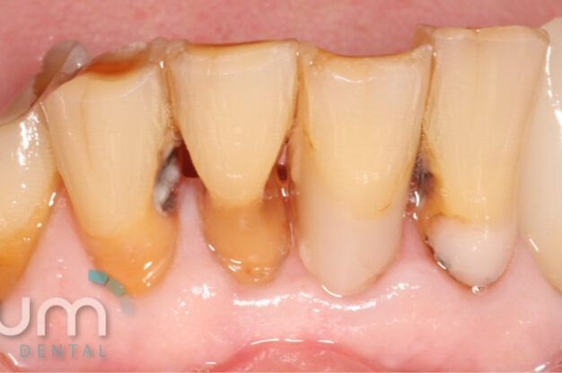CEREC (Crowns)-Before Img