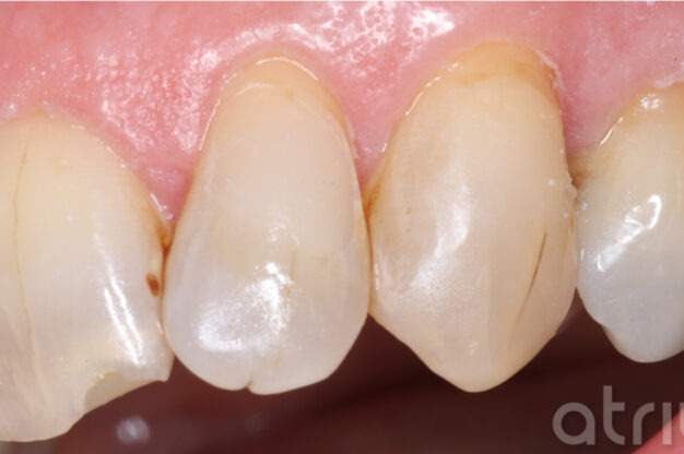 Composite Replacements-After Img