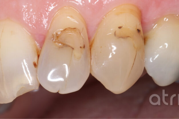 Composite Replacements-Before Img