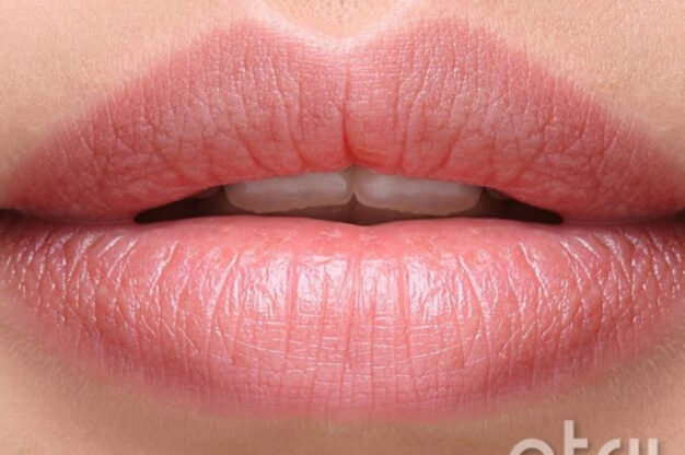 Dermal Fillers-After Img