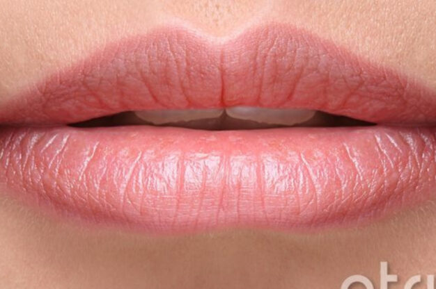 Dermal Fillers-Before Img