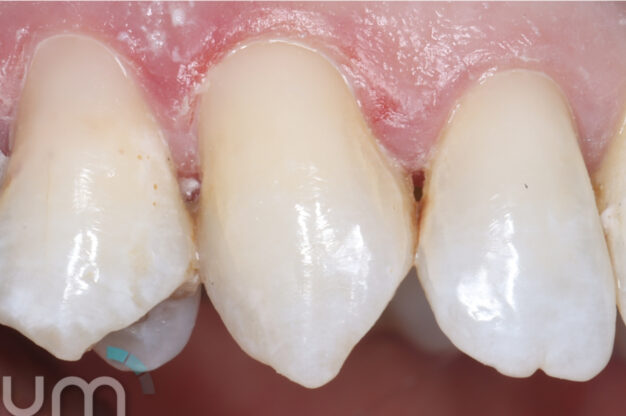 Replacement Filling-After Img