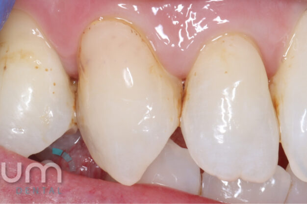 Replacement Filling-Before Img