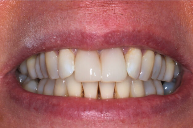 Veneers-After Img