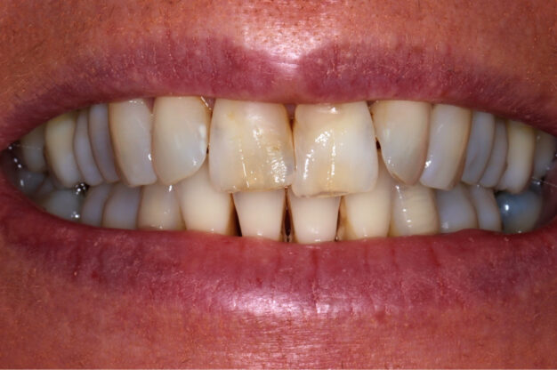 Veneers-Before Img