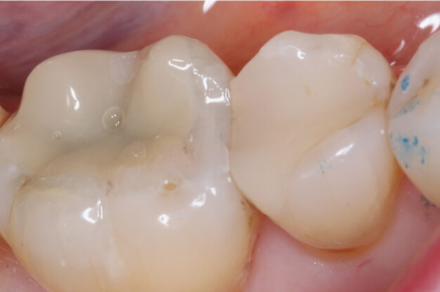 White Fillings-After Img