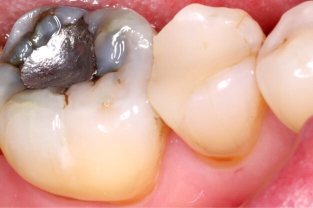 White Fillings-Before Img