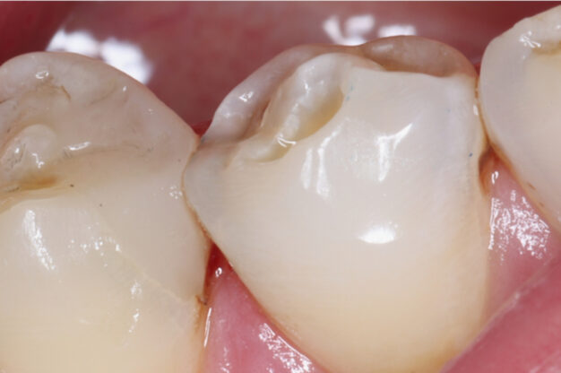 White Fillings-After Img