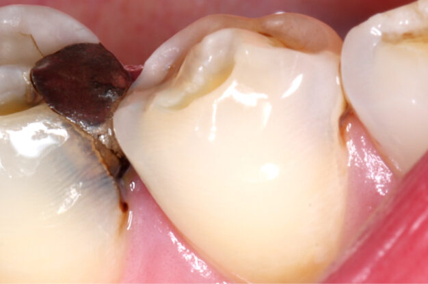 White Fillings-Before Img