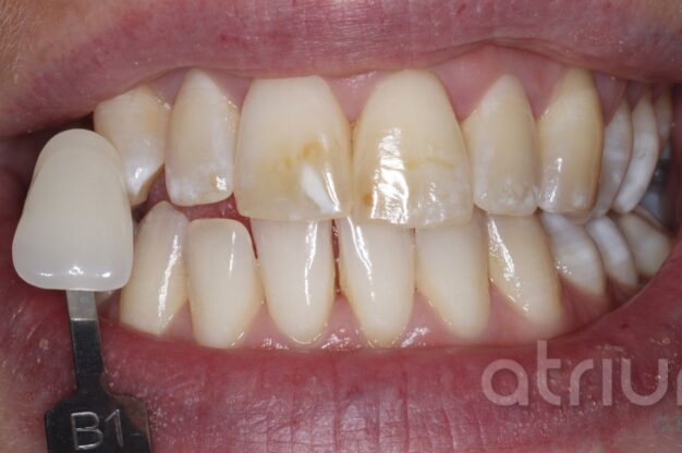 Enlighten Teeth Whitening-Before Img