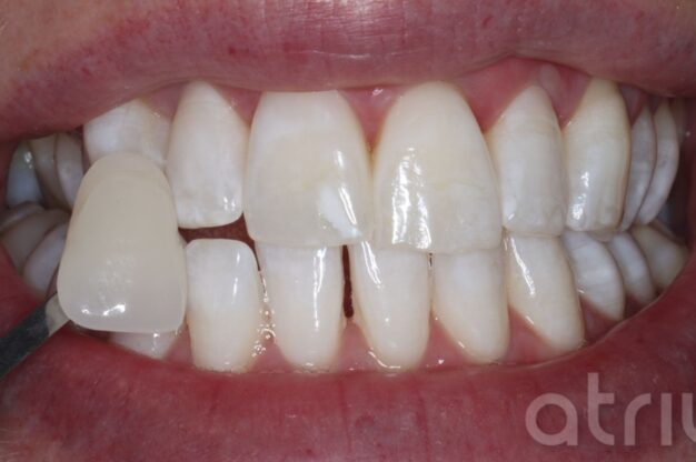 Enlighten Teeth Whitening-After Img