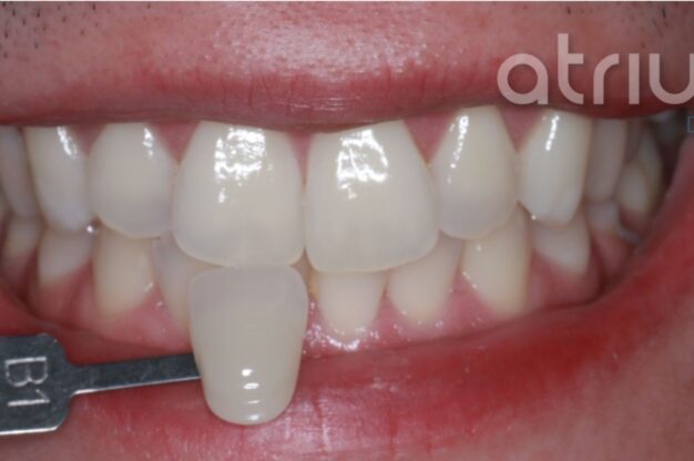 Philips Zoom-Whitening-After Img