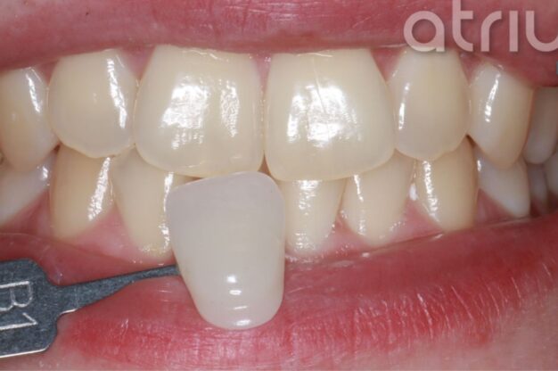Philips Zoom-Whitening-Before Img