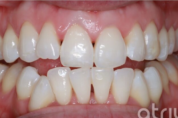 Philip At-Home Whitening-After Img