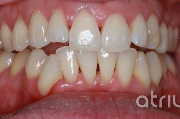 Philip At-Home Whitening-Before Img