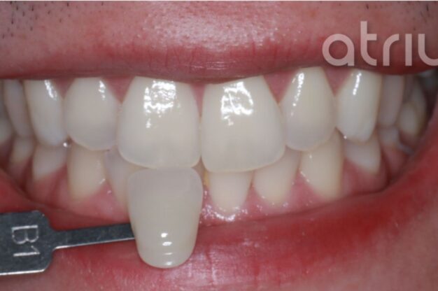 Philips Zoom-Whitening-After Img