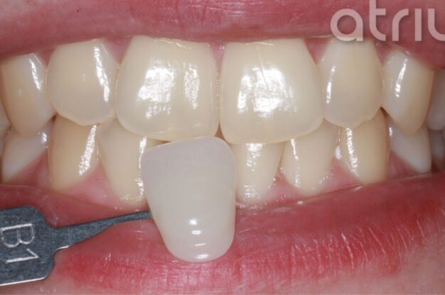 Philips Zoom-Whitening-Before Img