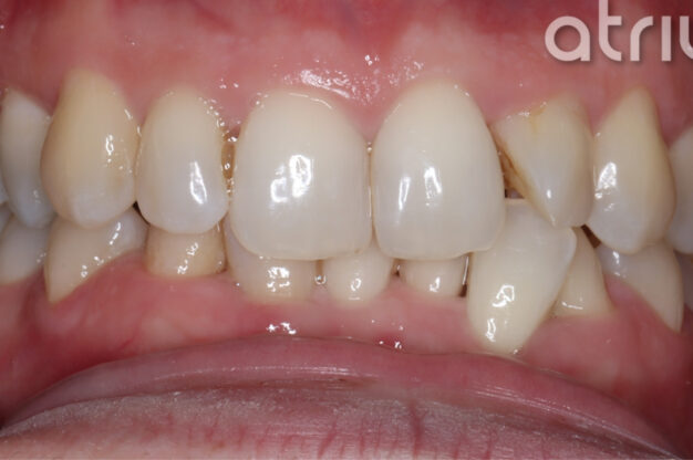Fixed Braces-Before Img