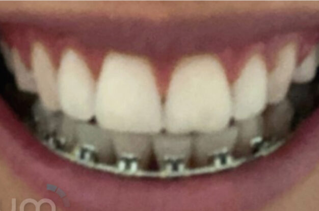 Fixed Braces-After Img