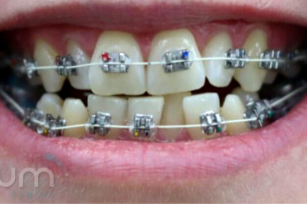 Fixed Braces-Before Img