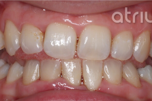 Dental Hygiene-After Img