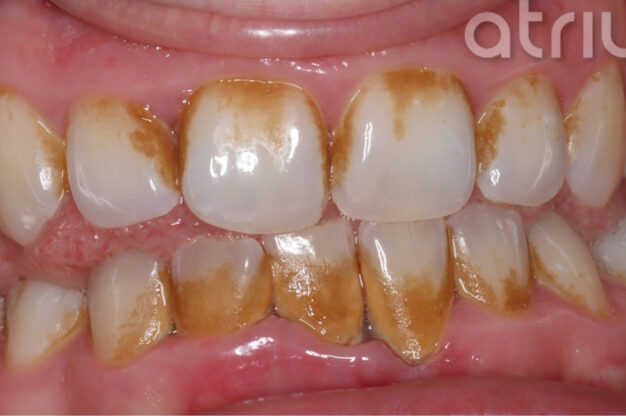 Dental Hygiene-Before Img