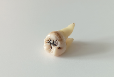 Modern Root Canal Treatment: Why It’s Nothing Like You’ve Heard