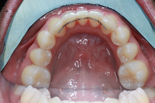 Fixed Braces – Lower Arch-After Img