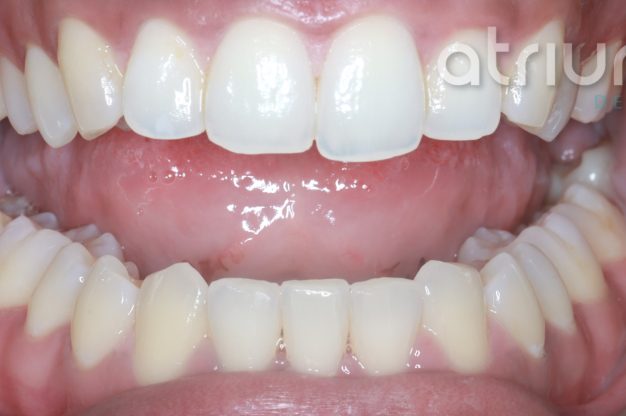 Fixed Braces – Lower Teeth-After Img