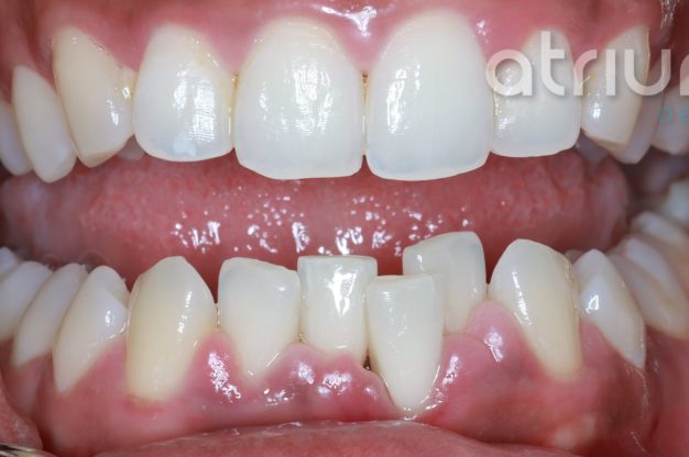 Fixed Braces – Lower Teeth-Before Img