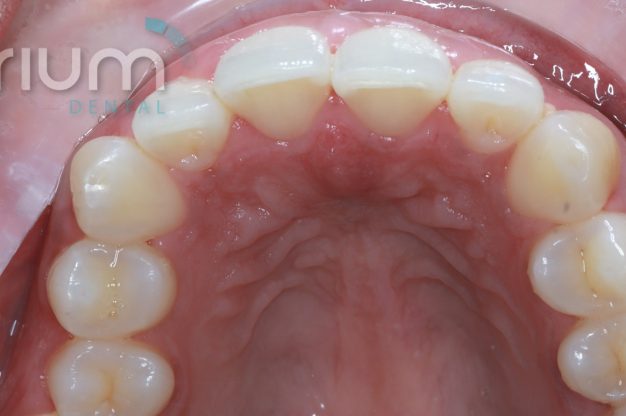 Fixed Braces – Lower Arch-After Img