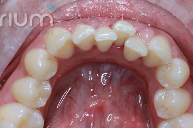 Fixed Braces – Lower Arch-Before Img